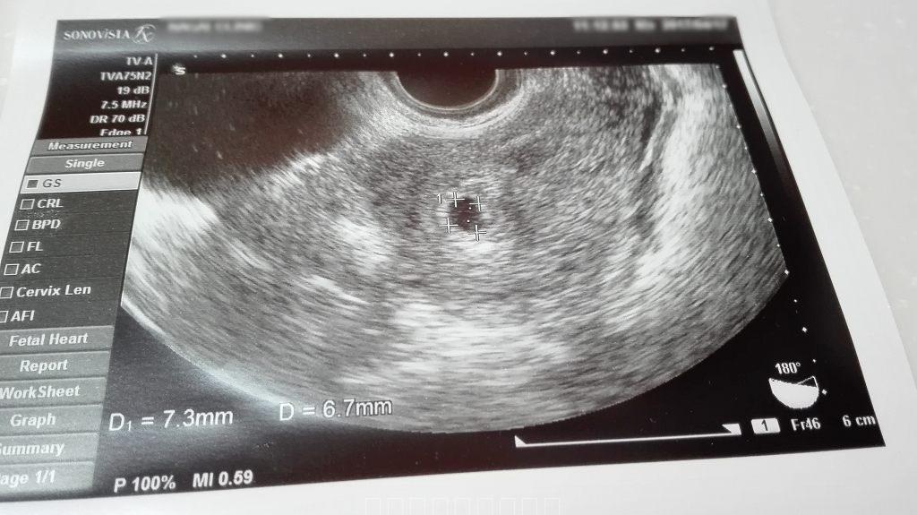 5w5d　妊娠5週　胎嚢小さい　6mm