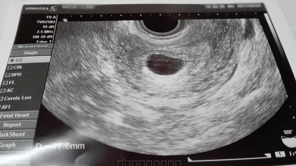 6w5d　妊娠6週　胎嚢からっぽ　17mm